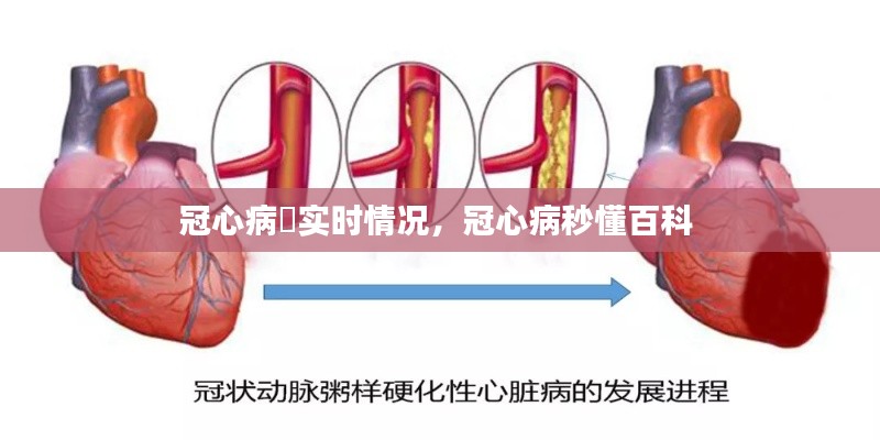 冠心病腅实时情况，冠心病秒懂百科 