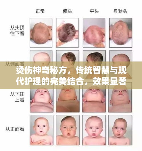 烫伤神奇秘方，传统智慧与现代护理的完美结合，效果显著！