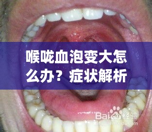 喉咙血泡变大怎么办？症状解析及应对建议